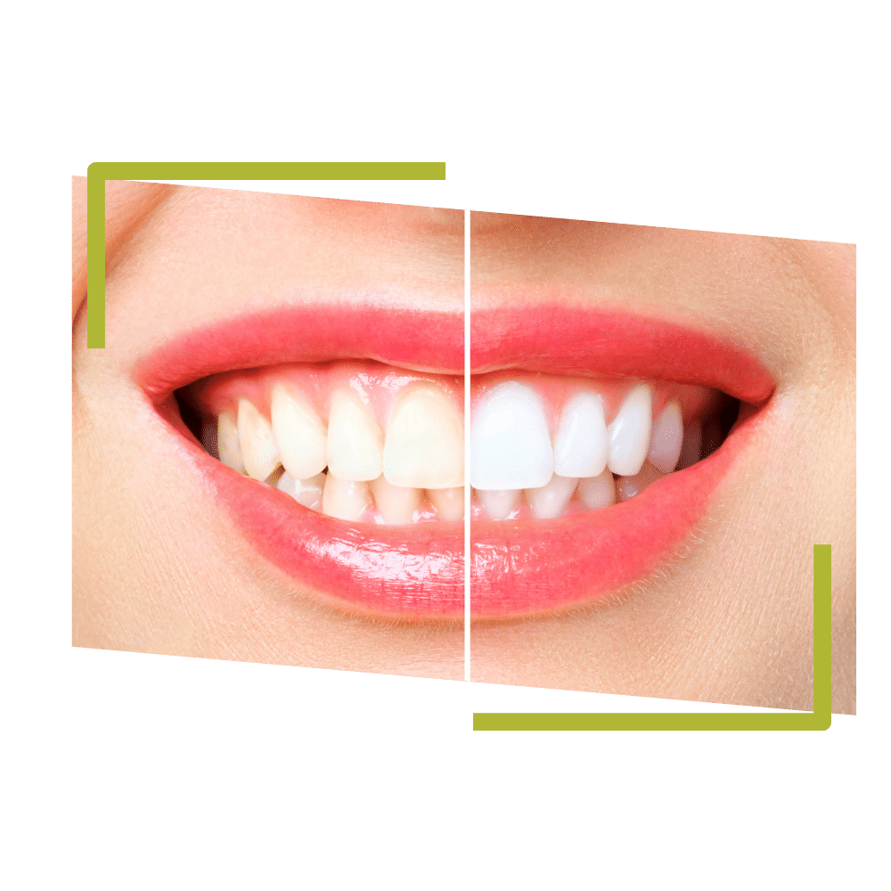 blaqueamiento-dental-erwin