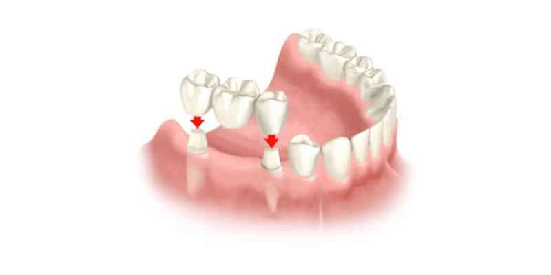 protesis-dentales-fijas