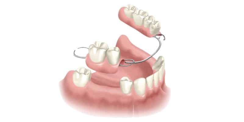 protesis-dentales-removibles