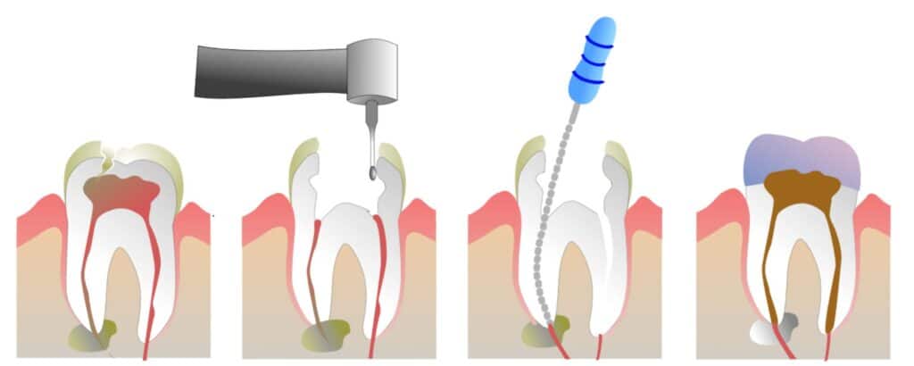 tecnicas-de-endodoncia-erwin-dental